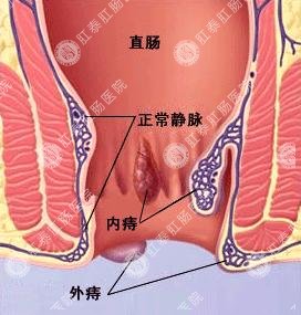 痔疮