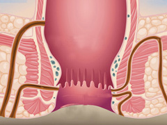 得了肛瘘我们怎么办