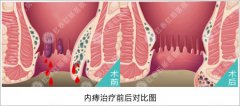 福州内痔怎么治效果果好？