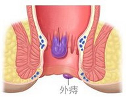 福州外痔选择哪种手术治疗好