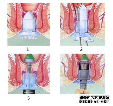 福州肛肠医院