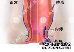 福州肛肠医院 福州医博肛肠医院 福州看痔疮的医院 福州肛瘘医院 福州肛裂医院 福州肠炎医院