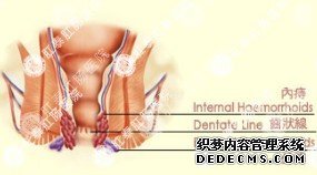 痔疮科普类图片