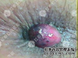 福州肛肠医院 福州医博肛肠医院 福州看痔疮的医院 福州肛瘘医院 福州肛裂医院 福州肠炎医院