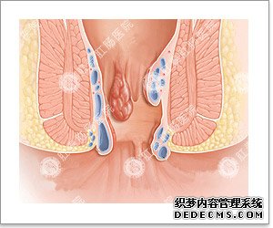 福州肛肠医院 福州医博肛肠医院 福州看痔疮的医院 福州肛瘘医院 福州肛裂医院 福州肠炎医院