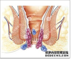 福州肛肠医院 福州医博肛肠医院 福州看痔疮的医院 福州肛瘘医院 福州肛裂医院 福州肠炎医院