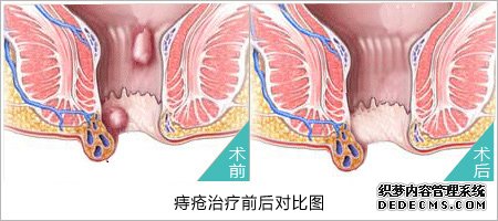 福州肛肠医院 福州医博肛肠医院 福州看痔疮的医院 福州肛瘘医院 福州肛裂医院 福州肠炎医院