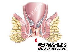 福州肛肠医院 福州医博肛肠医院 福州看痔疮的医院 福州肛瘘医院 福州肛裂医院 福州肠炎医院