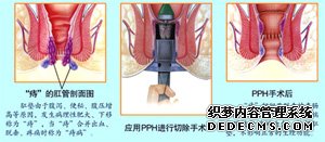 福州肛肠医院 福州医博肛肠医院 福州看痔疮的医院 福州肛瘘医院 福州肛裂医院 福州肠炎医院
