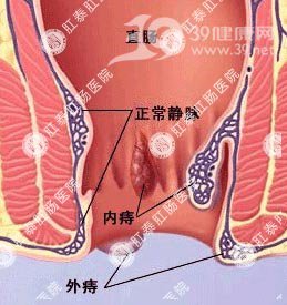 09全新剖析“痔疮”