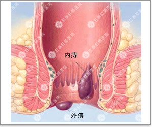 白领一族内痔的危害是什么_福建福州肛泰痔疮专科医院